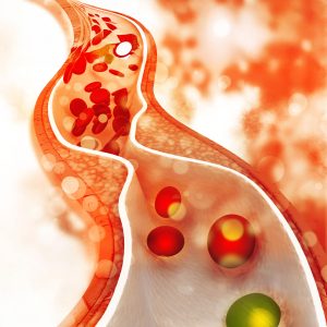 high cholesterol treatment in dubai